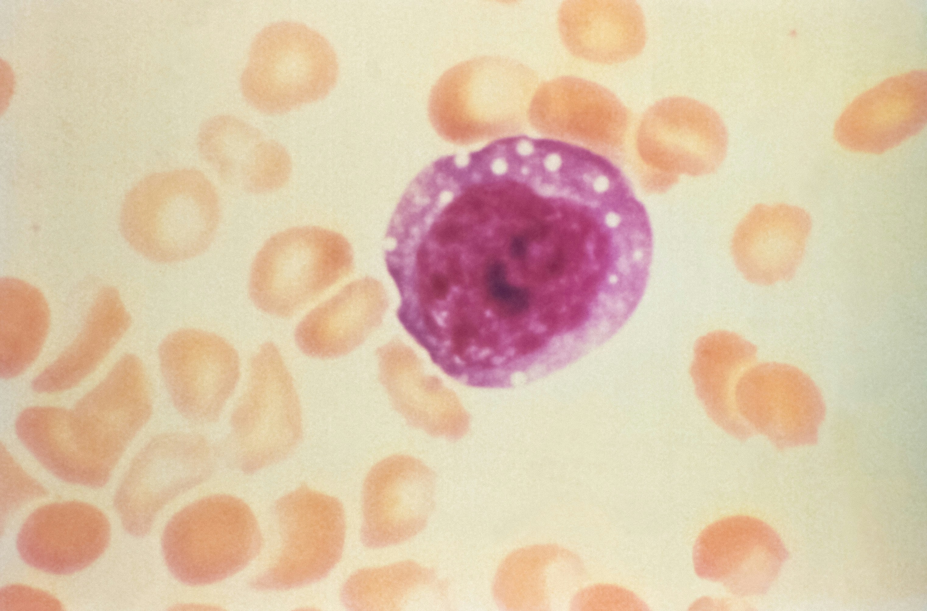 Polycythemia vera rusfertide hepcidin